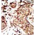 Formalin-fixed and paraffin-embedded human cancer tissue reacted with the primary antibody, which was peroxidase-conjugated to the secondary antibody, followed by AEC staining.