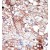 Formalin-fixed and paraffin-embedded human cancer tissue reacted with the primary antibody, which was peroxidase-conjugated to the secondary antibody, followed by DAB staining.