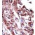 Formalin-fixed and paraffin-embedded human cancer tissue reacted with the primary antibody, which was peroxidase-conjugated to the secondary antibody, followed by AEC staining.
