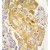 Formalin-fixed and paraffin-embedded human lung carcinoma tissue reacted with CYP8A1 antibody (N-term), which was peroxidase-conjugated to the secondary antibody, followed by DAB staining.