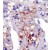 Formalin-fixed and paraffin-embedded human cancer tissue reacted with the primary antibody, which was peroxidase-conjugated to the secondary antibody, followed by AEC staining.