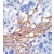Formalin-fixed and paraffin-embedded human cancer tissue reacted with the primary antibody, which was peroxidase-conjugated to the secondary antibody, followed by AEC staining.
