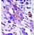Formalin-fixed and paraffin-embedded human cancer tissue reacted with the primary antibody, which was peroxidase-conjugated to the secondary antibody, followed by AEC staining.