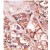 Formalin-fixed and paraffin-embedded human cancer tissue reacted with the primary antibody, which was peroxidase-conjugated to the secondary antibody, followed by AEC staining. This data demonstrates the use of this antibody for immunohistochemistry; clinical relevance has not been evaluated.
