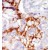 Formalin-fixed and paraffin-embedded human cancer tissue reacted with the primary antibody, which was peroxidase-conjugated to the secondary antibody, followed by AEC staining.