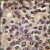 Formalin-fixed and paraffin-embedded human prostata carcinoma tissue reacted with PKN beta antibody (C-term), which was peroxidase-conjugated to the secondary antibody, followed by DAB staining.