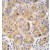 Formalin-fixed and paraffin-embedded human hepatocarcinoma tissue reacted with ALDH9A1 antibody (C-term), which was peroxidase-conjugated to the secondary antibody, followed by DAB staining.