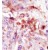 Formalin-fixed and paraffin-embedded human cancer tissue reacted with the primary antibody, which was peroxidase-conjugated to the secondary antibody, followed by AEC staining.