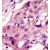 Formalin-fixed and paraffin-embedded human cancer tissue reacted with the primary antibody, which was peroxidase-conjugated to the secondary antibody, followed by DAB staining.