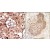 (LEFT)Formalin-fixed and paraffin-embedded human cancer tissue reacted with the primary antibody, which was peroxidase-conjugated to the secondary antibody, followed by AEC staining.  (RIGHT)Formalin-fixed and paraffin-embedded human lung carcinoma tissue reacted with RIPK2 Antibody (C-term), which was peroxidase-conjugated to the secondary antibody, followed by DAB staining.