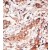 Formalin-fixed and paraffin-embedded human cancer tissue reacted with the primary antibody, which was peroxidase-conjugated to the secondary antibody, followed by DAB staining.