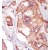 Formalin-fixed and paraffin-embedded human cancer tissue reacted with the primary antibody, which was peroxidase-conjugated to the secondary antibody, followed by AEC staining.