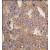Formalin-fixed and paraffin-embedded human prostata carcinoma tissue reacted with NARS2 antibody (C-term), which was peroxidase-conjugated to the secondary antibody, followed by DAB staining.