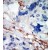 Formalin-fixed and paraffin-embedded human cancer tissue reacted with the primary antibody, which was peroxidase-conjugated to the secondary antibody, followed by DAB staining.