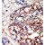 Formalin-fixed and paraffin-embedded human cancer tissue reacted with the primary antibody, which was peroxidase-conjugated to the secondary antibody, followed by DAB staining.