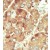 Formalin-fixed and paraffin-embedded human cancer tissue reacted with the primary antibody, which was peroxidase-conjugated to the secondary antibody, followed by DAB staining.