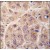 Formalin-fixed and paraffin-embedded human hepatocarcinoma tissue reacted with PIM3 antibody (C-term), which was peroxidase-conjugated to the secondary antibody, followed by DAB staining.