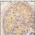 Formalin-fixed and paraffin-embedded human prostata carcinoma tissue reacted with CAMKK2 antibody (N-term), which was peroxidase-conjugated to the secondary antibody, followed by DAB staining.