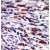 Formalin-fixed and paraffin-embedded human cancer tissue reacted with the primary antibody, which was peroxidase-conjugated to the secondary antibody, followed by AEC staining.