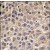 Formalin-fixed and paraffin-embedded human hepatocarcinoma tissue reacted with MTMR8 antibody (C-term), which was peroxidase-conjugated to the secondary antibody, followed by DAB staining.