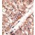 Formalin-fixed and paraffin-embedded human cancer tissue reacted with the primary antibody, which was peroxidase-conjugated to the secondary antibody, followed by AEC staining.