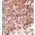 Formalin-fixed and paraffin-embedded human cancer tissue reacted with the primary antibody, which was peroxidase-conjugated to the secondary antibody, followed by DAB staining.