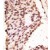 Formalin-fixed and paraffin-embedded human cancer tissue reacted with the primary antibody, which was peroxidase-conjugated to the secondary antibody, followed by AEC staining.