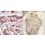 (LEFT)Formalin-fixed and paraffin-embedded human cancer tissue reacted with the primary antibody, which was peroxidase-conjugated to the secondary antibody, followed by DAB staining.  (RIGHT)Formalin-fixed and paraffin-embedded human lung carcinoma tissue reacted with MAGEA1 Antibody (Center), which was peroxidase-conjugated to the secondary antibody, followed by DAB staining.