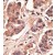 Formalin-fixed and paraffin-embedded human cancer tissue reacted with the primary antibody, which was peroxidase-conjugated to the secondary antibody, followed by DAB staining.
