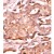 Formalin-fixed and paraffin-embedded human cancer tissue reacted with the primary antibody, which was peroxidase-conjugated to the secondary antibody, followed by AEC staining. This data demonstrates the use of this antibody for immunohistochemistry; clinical relevance has not been evaluated.