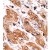 AP12573PU-N BIK antibody staining of Formalin-Fixed and Paraffin-Embedded Human cancer tissue. The primary antibody, which was peroxidase-conjugated to the secondary antibody, followed by AEC staining. This data demonstrates the use of this antibody for immunohistochemistry; clinical relevance has not been evaluated.