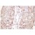 Immunohistochemistry (IHC) analyzes of SENP1 antibody (Cat.-No.: AP06456PU-N) in paraffin-embedded human breast carcinoma tissue.
