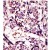 Formalin-fixed and paraffin-embedded human cancer tissue reacted with the primary antibody, which was peroxidase-conjugated to the secondary antibody, followed by DAB staining. This data demonstrates the use of this antibody for immunohistochemistry; clinical relevance has not been evaluated.