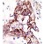 Formalin-fixed and paraffin-embedded human cancer tissue reacted with the primary antibody, which was peroxidase-conjugated to the secondary antibody, followed by DAB staining. This data demonstrates the use of this antibody for immunohistochemistry; clinical relevance has not been evaluated.