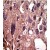 Formalin-fixed and paraffin-embedded human cancer tissue reacted with the primary antibody, which was peroxidase-conjugated to the secondary antibody, followed by DAB staining. This data demonstrates the use of this antibody for immunohistochemistry; clinical relevance has not been evaluated.
