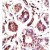 Formalin-fixed and paraffin-embedded human cancer tissue reacted with the primary antibody, which was peroxidase-conjugated to the secondary antibody, followed by DAB staining. This data demonstrates the use of this antibody for immunohistochemistry; clinical relevance has not been evaluated.
