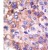 Formalin-fixed and paraffin-embedded human cancer tissue reacted with the primary antibody, which was peroxidase-conjugated to the secondary antibody, followed by DAB staining. This data demonstrates the use of this antibody for immunohistochemistry; clinical relevance has not been evaluated.