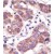 Formalin-fixed and paraffin-embedded human cancer tissue reacted with the primary antibody, which was peroxidase-conjugated to the secondary antibody, followed by DAB staining. This data demonstrates the use of this antibody for immunohistochemistry; clinical relevance has not been evaluated.