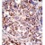 Formalin-fixed and paraffin-embedded human cancer tissue reacted with the primary antibody, which was peroxidase-conjugated to the secondary antibody, followed by DAB staining. This data demonstrates the use of this antibody for immunohistochemistry; clinical relevance has not been evaluated.