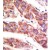 Formalin-fixed and paraffin-embedded human cancer tissue reacted with the primary antibody, which was peroxidase-conjugated to the secondary antibody, followed by AEC staining. This data demonstrates the use of this antibody for immunohistochemistry; clinical relevance has not been evaluated.