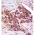Formalin-fixed and paraffin-embedded human cancer tissue reacted with the primary antibody, which was peroxidase-conjugated to the secondary antibody, followed by DAB staining. This data demonstrates the use of this antibody for immunohistochemistry; clinical relevance has not been evaluated.