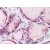 Thyroid: Formalin-Fixed, Paraffin-Embedded (FFPE)