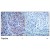 Figure 1. Immunohistochemical analysis of paraffin- embedded human breast carcinoma tissue using HDAC2 antibody AP02667PU.