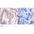 Figure 1. Immunohistochemical analysis of paraffin-embedded human lung carcinoma tissue using eIF4B Antibody (#AP09474PU) (Left) or the same antibody preincubated with blocking peptide (Right).