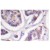 Immunohistochemistry (IHC) analyzes of Vinculin antibody (Cat.-No.: AP06605PU-N) in paraffin-embedded Human breast carcinoma tissue.