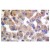 Immunohistochemistry (IHC) analyzes of TGF-beta1 antibody (Cat.-No.: AP06350PU-N) in paraffin-embedded human breast carcinoma tissue.