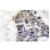 Immunohistochemistry Analysis: AP20200PU-N Synaptotagmin antibody staining of Paraffin-Embedded Human breast carcinoma tissue.