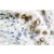 Immunohistochemistry (IHC) analysis of ERCC1 antibody (Cat.-No.: AP06106PU-N) in paraffin-embedded human lung carcinoma tissue.