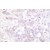 Immunohistochemistry analysis of POLR2A antibody (Cat.-No. AP06407PU-N) in paraffin-embedded human breast carcinoma tissue.
