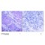 Figure 1. Immunohistochemical analysis of paraffin- embedded human breast carcinoma tissue using PDK1 antibody (Phospho-Ser241) Cat. AP02307PU